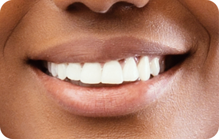 Close-up of a smiling female patient showing healthy, white, and well-aligned teeth.