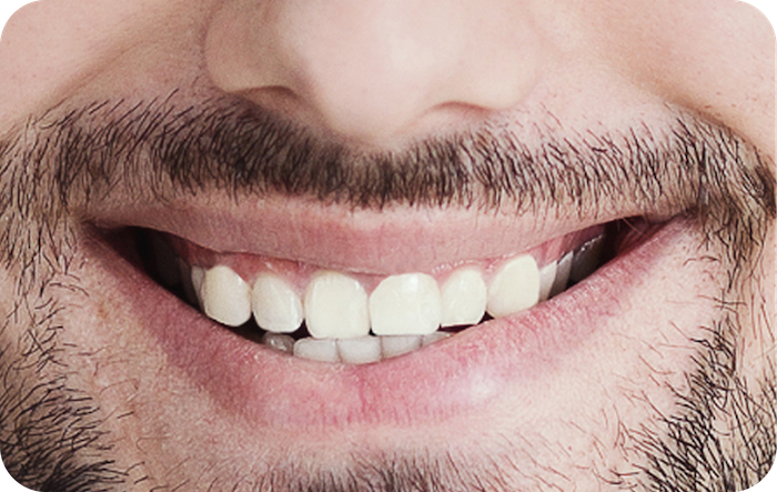 Close-up of a smiling male patient showing a small gap between the upper front teeth.