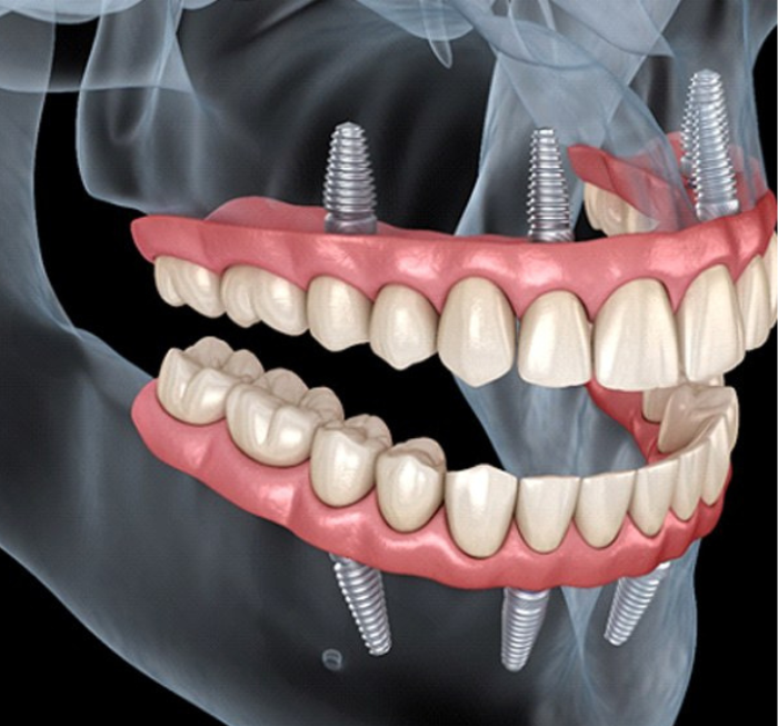 The Complete Truth About Dental Implants