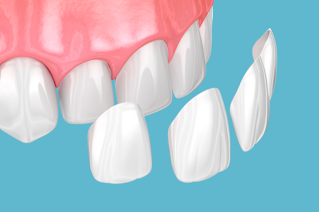 What are Dental Veneers