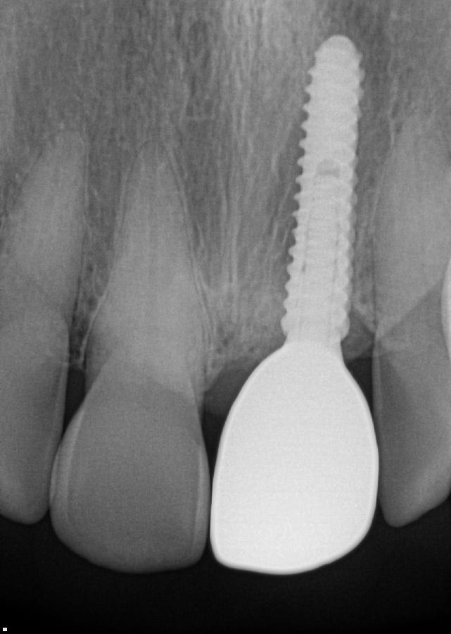 Radiografia odontológica mostrando implante dentário na região anterior da boca.