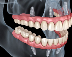 The Complete Truth About Dental Implants