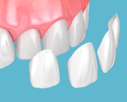 What are Dental Veneers